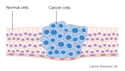 ung thư là gì?