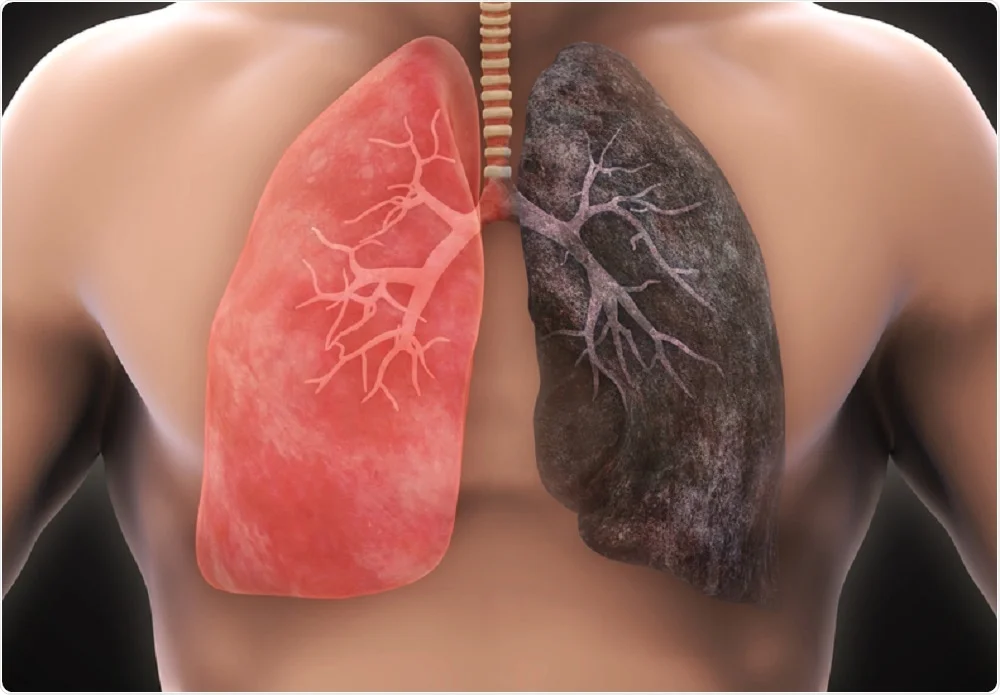 Các yếu tố làm tăng nguy cơ ung thư phổi