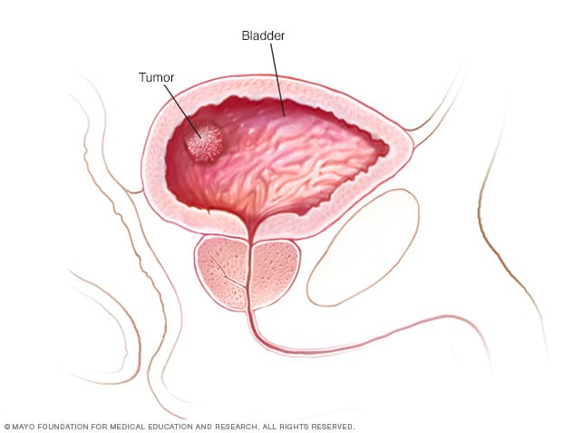 Ung thư bàng quang tràng là gì? Những điều nam giới cần biết