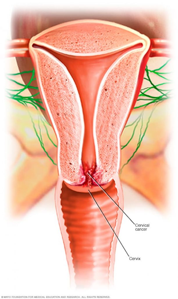 Ung thư cổ tử cung bắt đầu trong các tế bào của cổ tử cung.